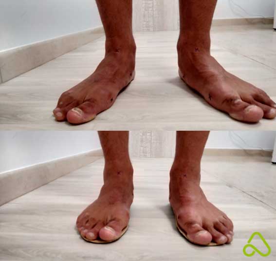 Corrección de pies planos con plantilla